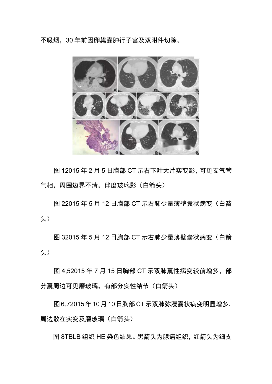 外科医师师晋升副主任医师专题报告病例分析（双肺弥漫囊性病变病例分析）.docx_第3页