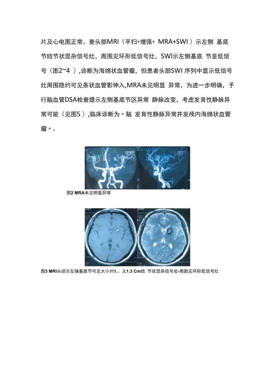 颅内脑发育性静脉异常并发海绵状血管瘤病例分析专题报告.docx_第3页