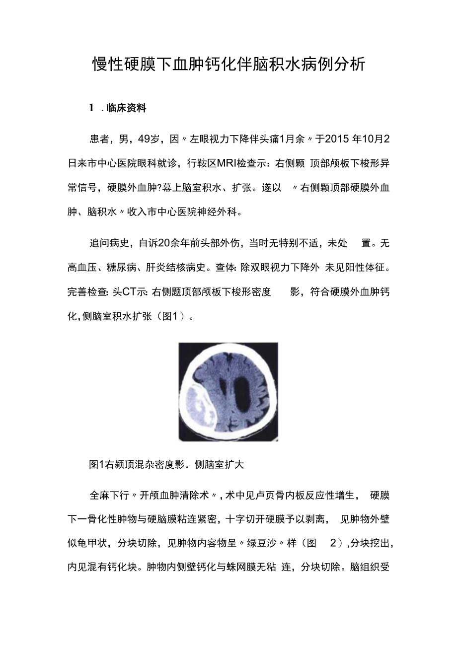 眼科医师晋升副主任（主任）医师高级职称病例分析专题报告（慢性硬膜下血肿钙化伴脑积水）.docx_第2页