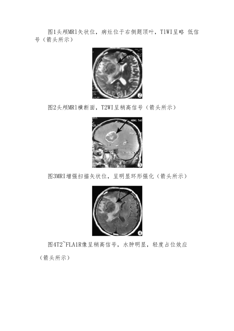 神经内科医师医师晋升副主任（主任）医师例分析专题报告（一例左侧口角歪斜左侧肢体乏力诊断分析）.docx_第3页