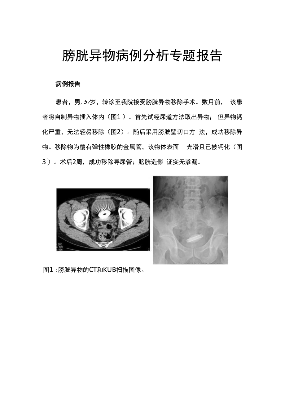 膀胱异物病例分析专题报告.docx_第1页