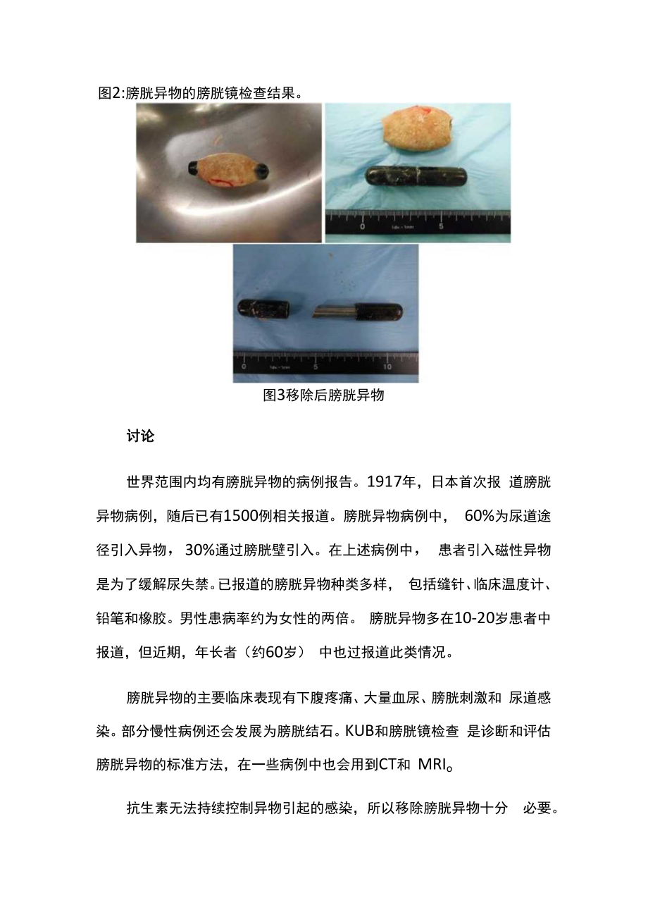 膀胱异物病例分析专题报告.docx_第2页