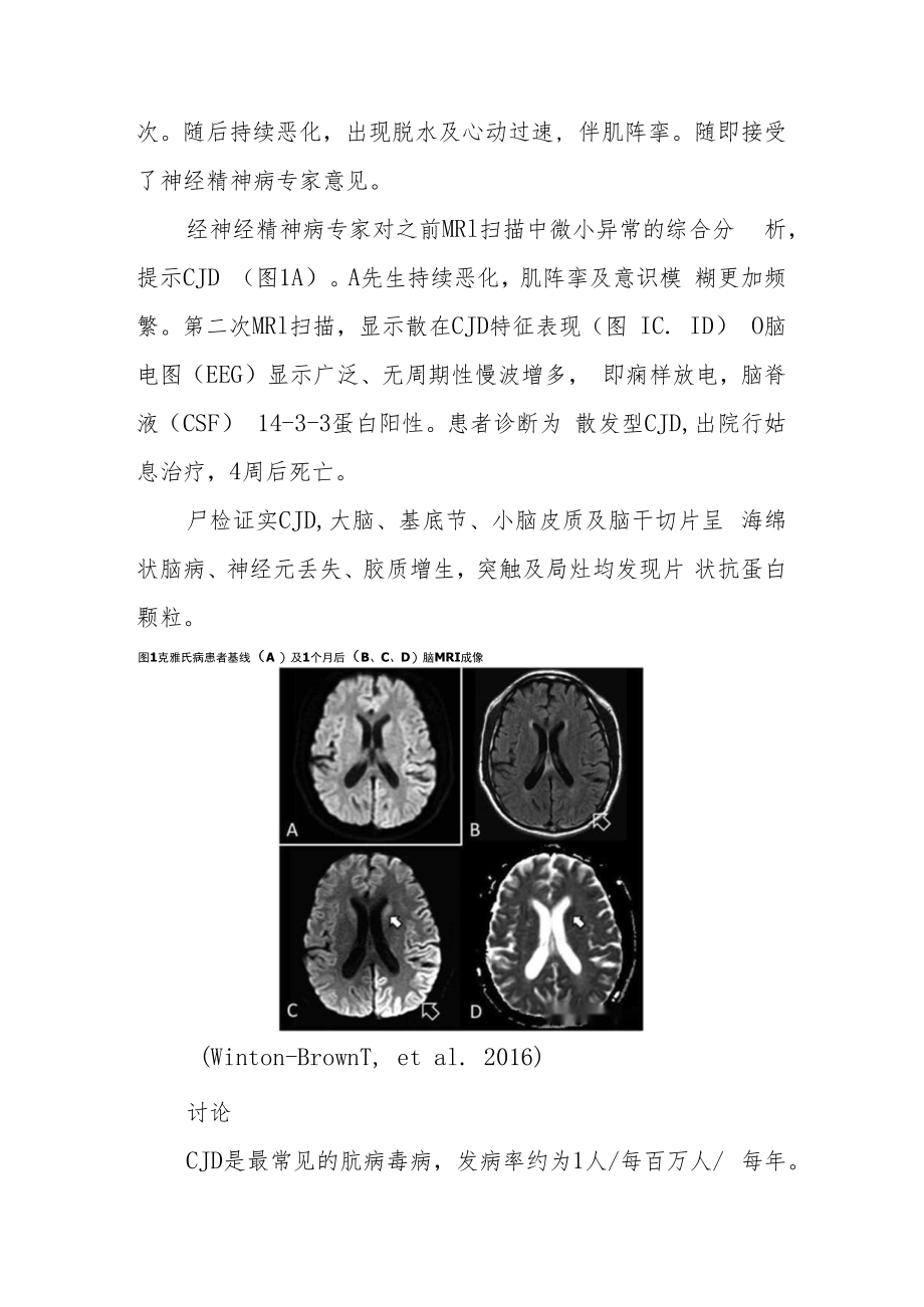 精神科医师医师晋升副主任（主任）医师高级职称例分析专题报告（以紧张症为表现的克雅氏病病例分析）.docx_第3页