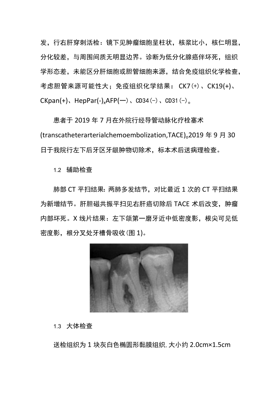 肝内胆管细胞癌牙龈转移病例分析.docx_第2页