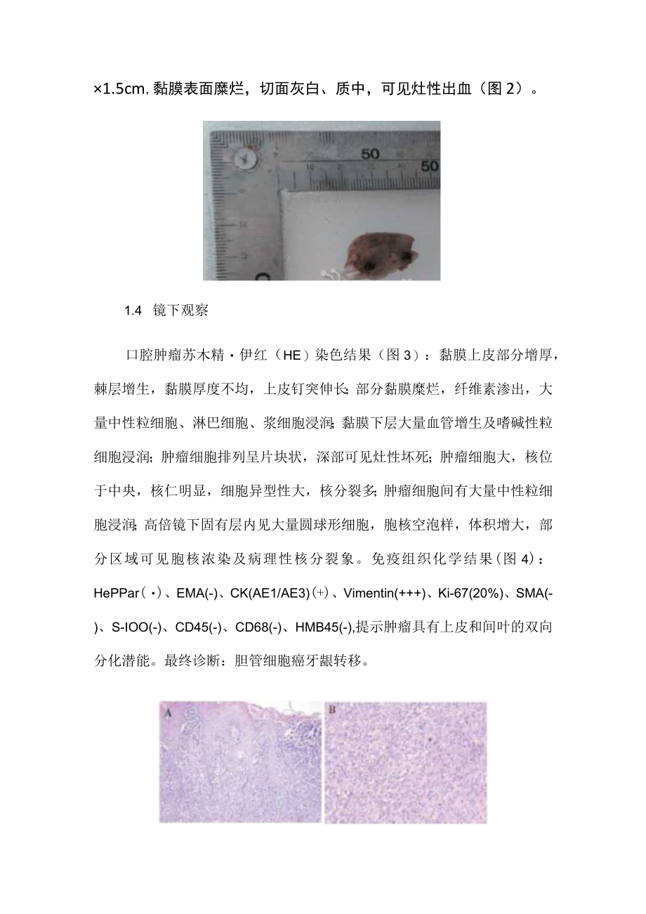 肝内胆管细胞癌牙龈转移病例分析.docx_第3页