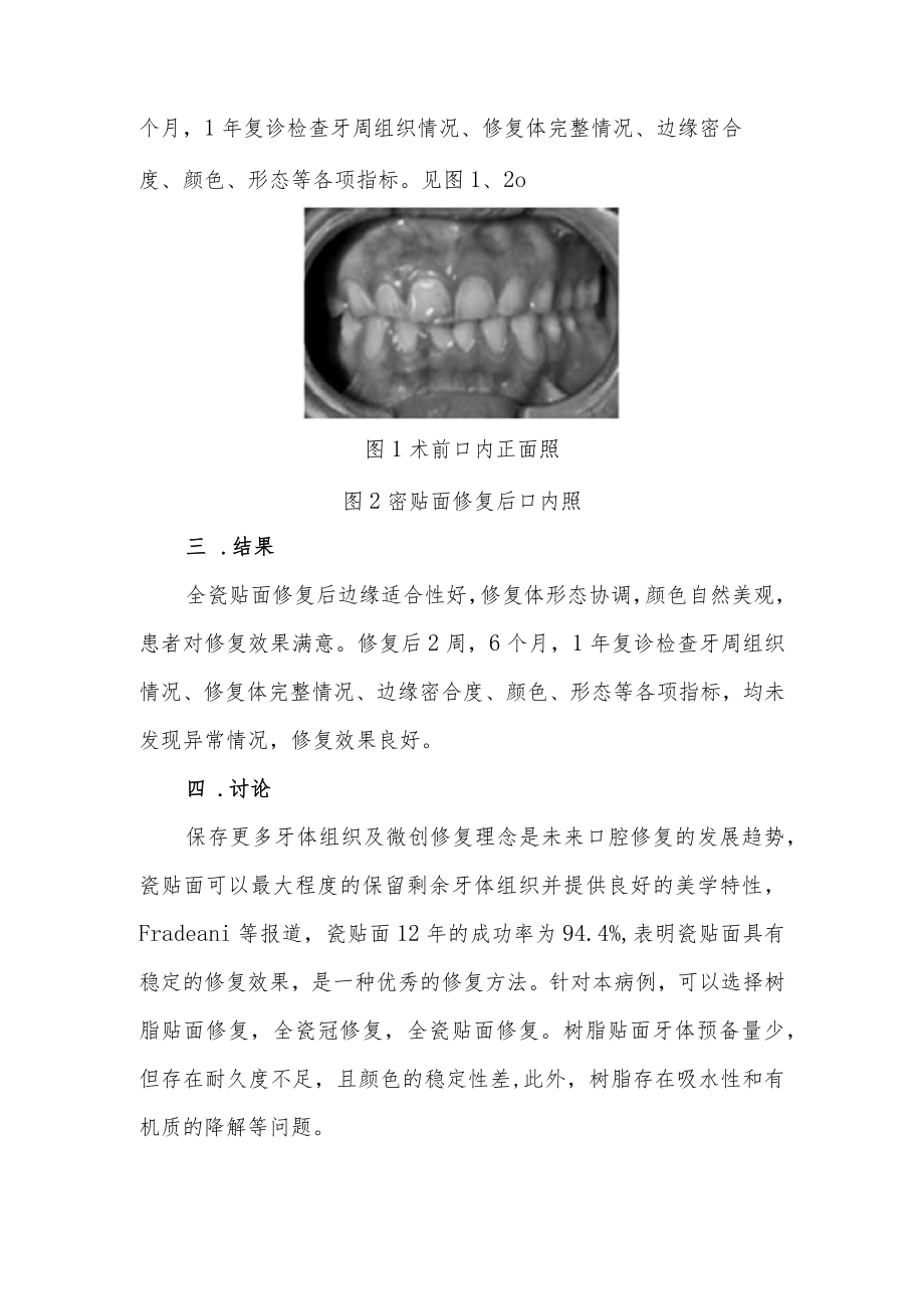 口腔科晋升副主任（主任）医师病例分析专题报告（瓷贴面修复上颌切牙牙体缺损病例报告）.docx_第3页