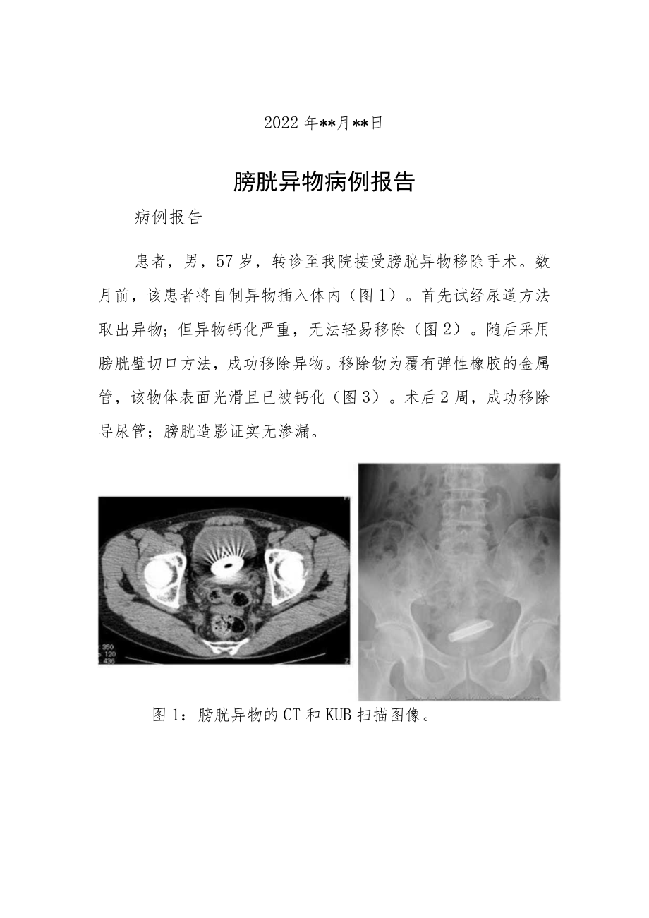 泌尿科晋升副主任（主任）医师病例分析专题报告（膀胱异物病例报告）.docx_第2页