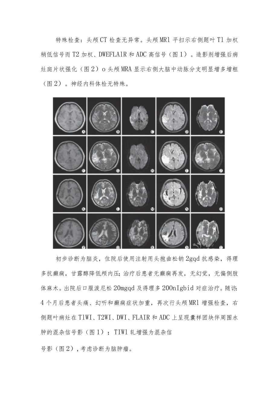 神经外科晋升副主任医师高级职称病例分析专题报告汇编3篇.docx_第3页