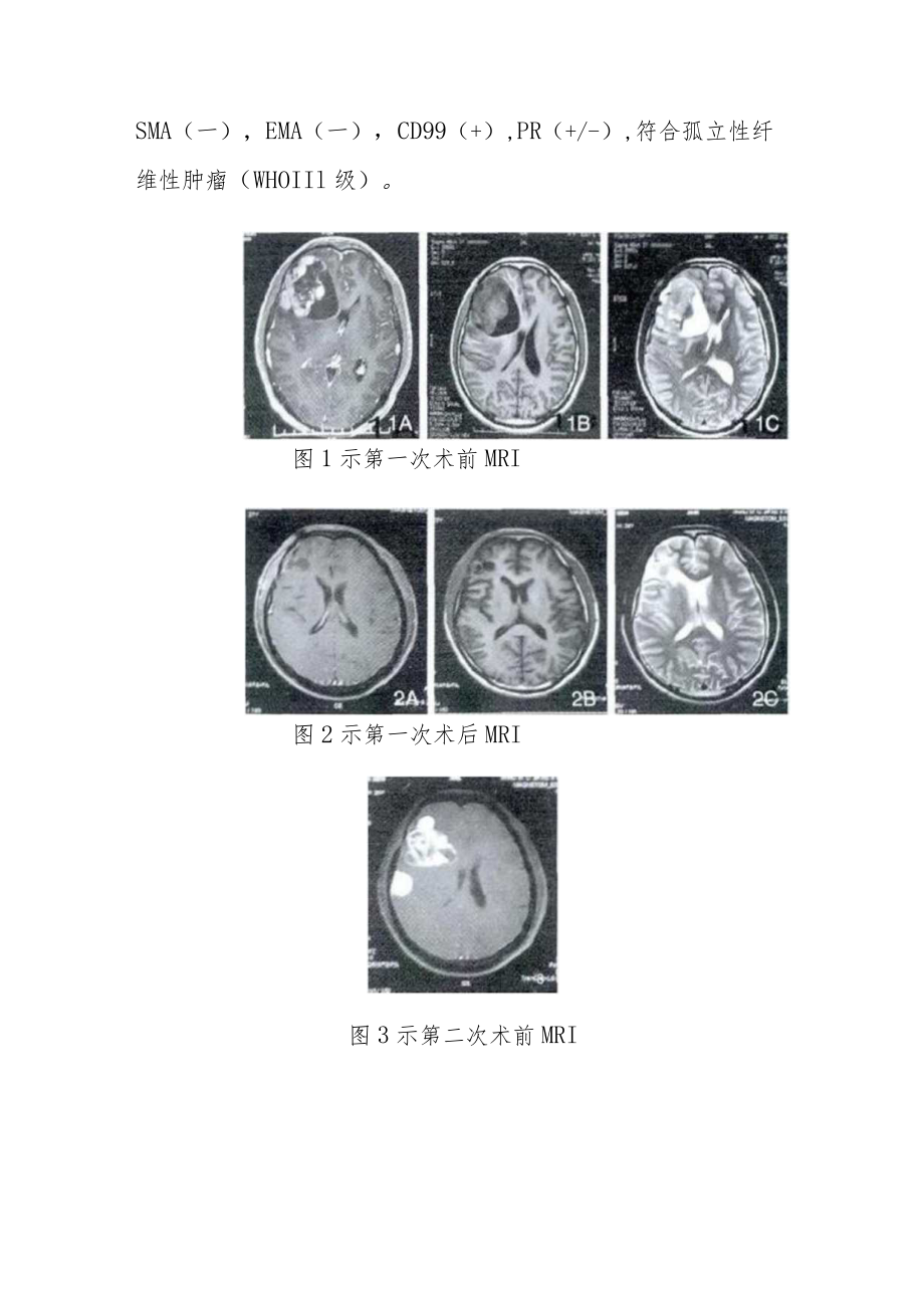 肿瘤科晋升副主任医师高级职称病例分析专题报告汇编三篇.docx_第3页