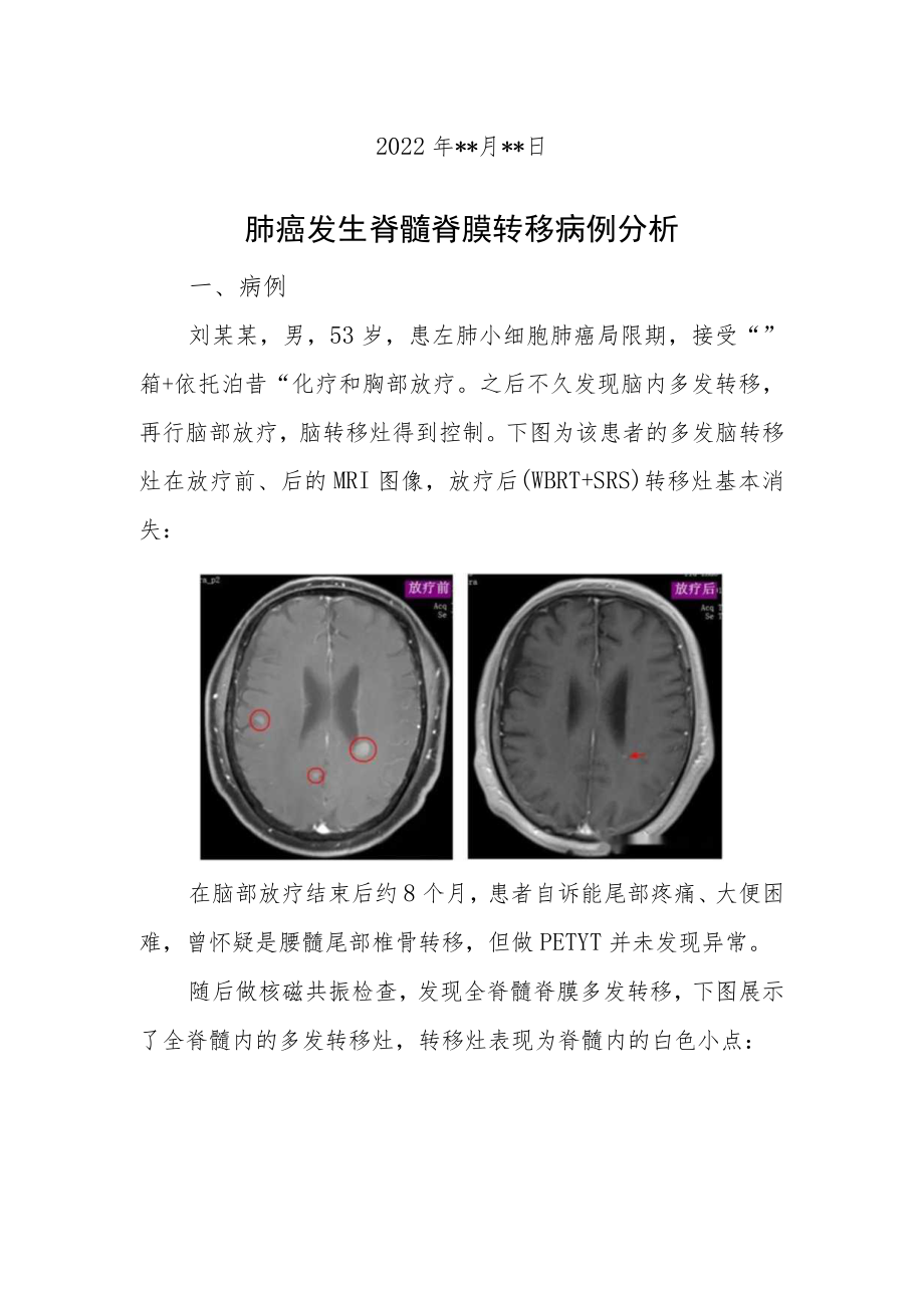 肿瘤科晋升副主任医师高级职称病例分析专题报告汇编3篇.docx_第2页