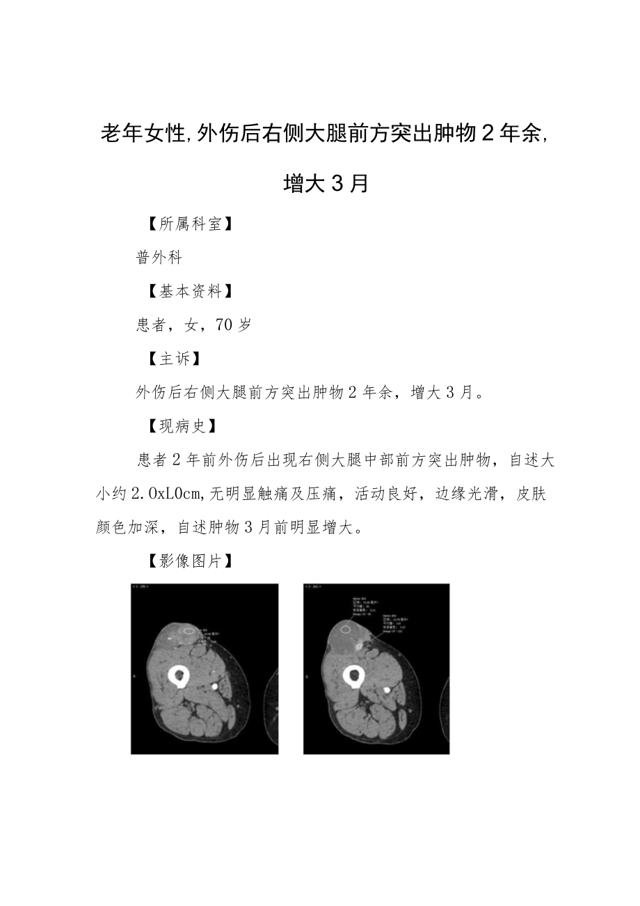 外科医师晋升副主任（主任）医师高级职称专题报告病例分析报告3篇.docx_第3页