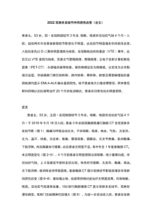 2022双肺多发结节伴间质性改变（全文）.docx