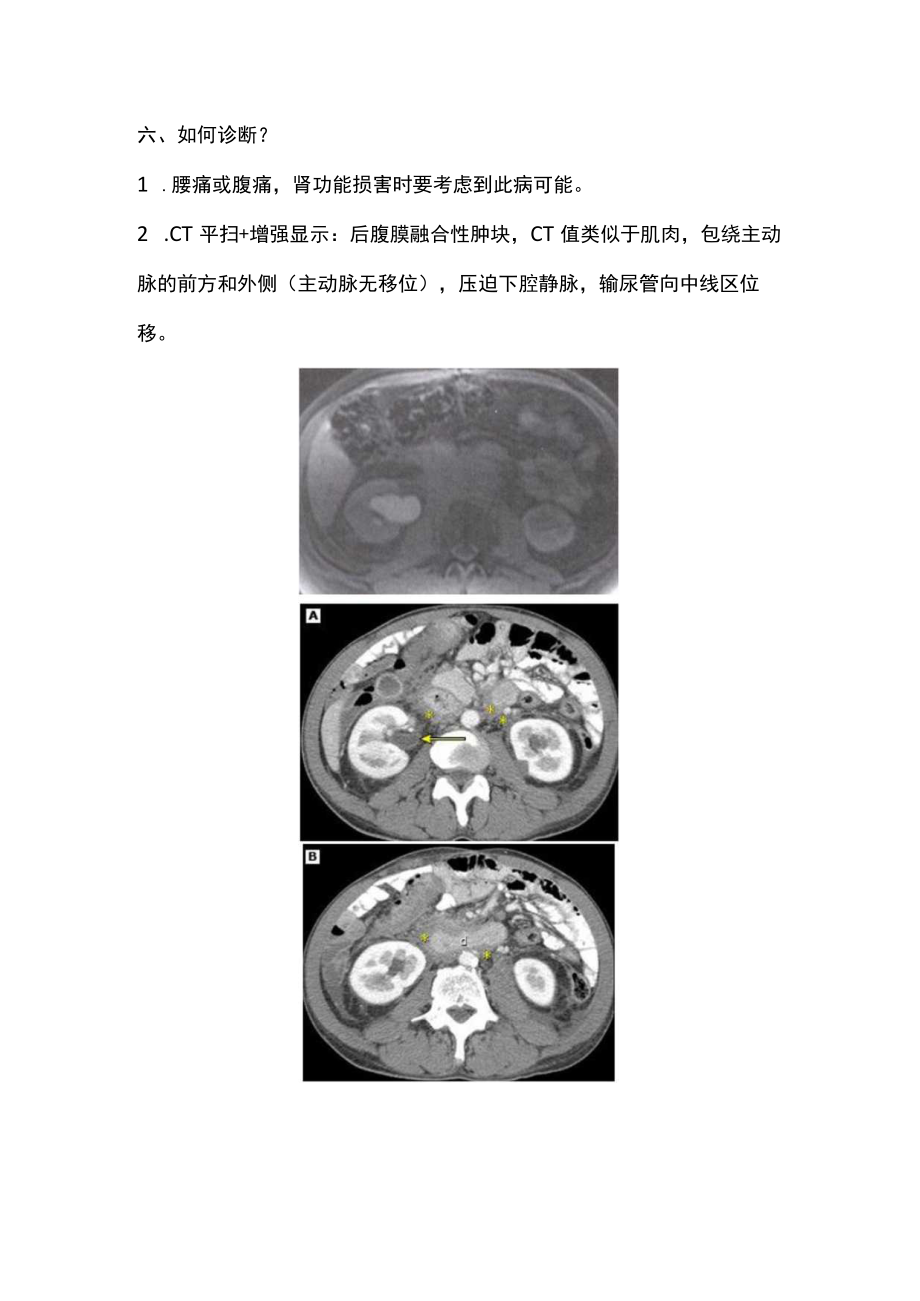 2022腹膜后纤维化（全文）.docx_第3页