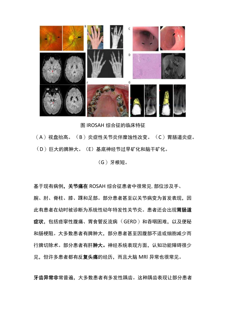 2022ROSAH综合征的临床特点与治疗（全文）.docx_第2页