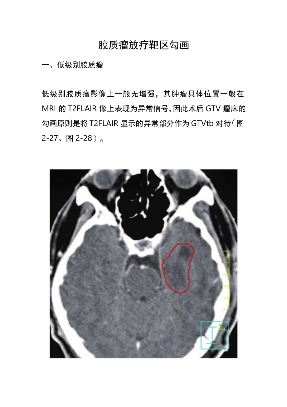 胶质瘤放疗靶区勾画.docx_第1页