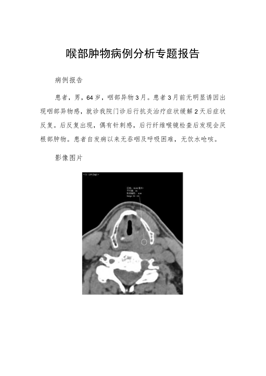 喉部肿物病例分析专题报告.docx_第1页