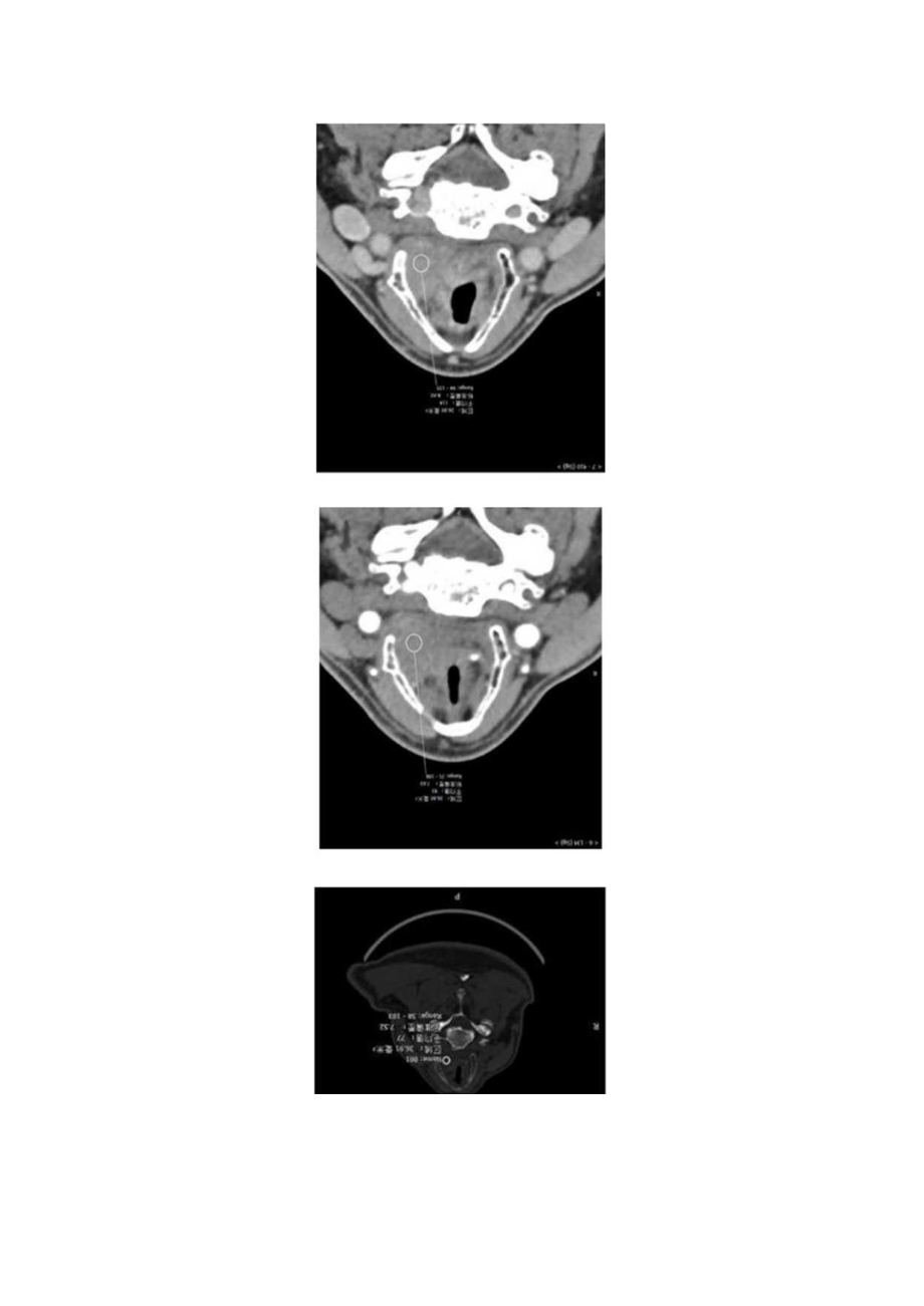喉部肿物病例分析专题报告.docx_第2页