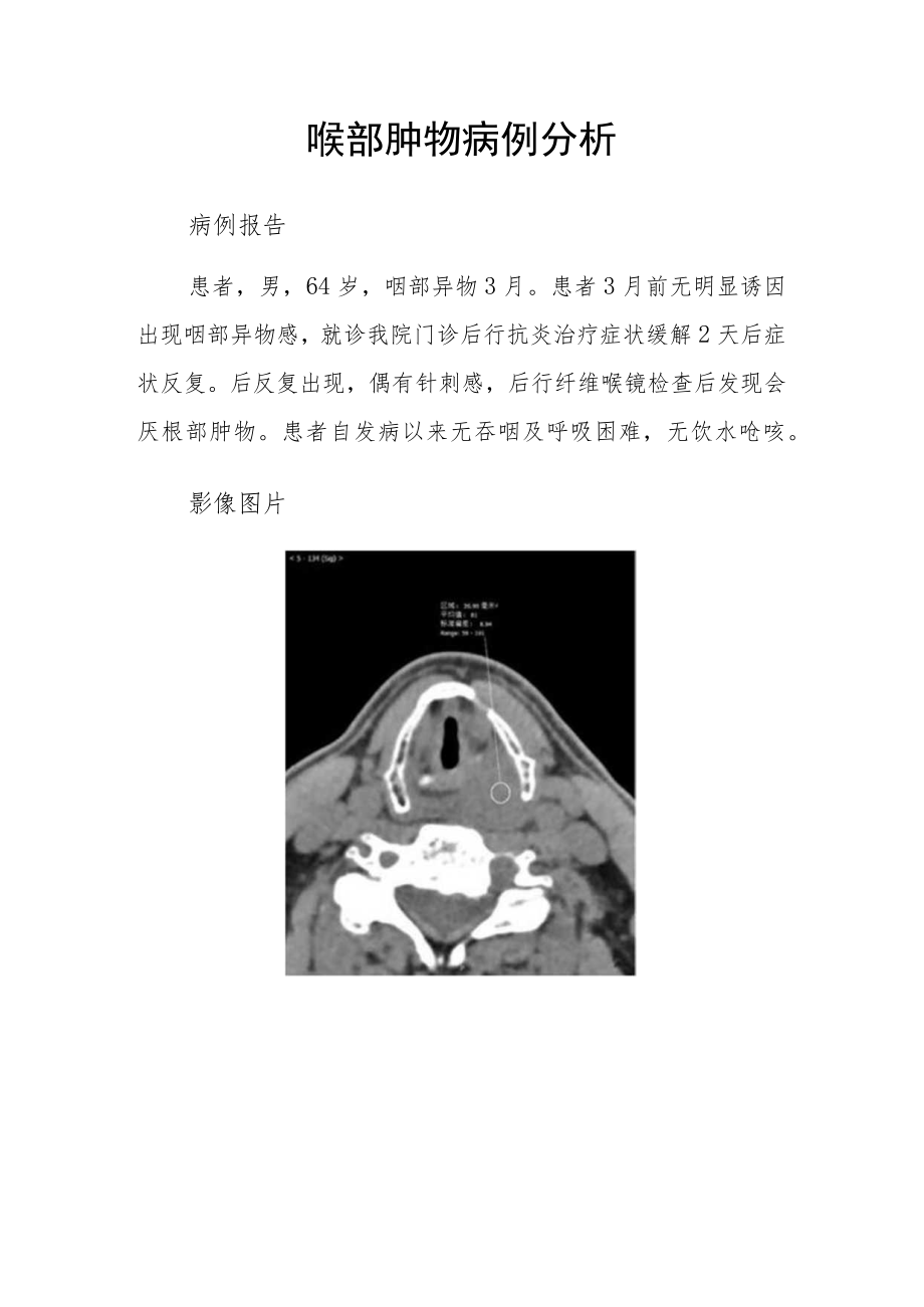 耳鼻喉科晋升副主任（主任）医师病例分析专题报告（喉部肿物）.docx_第2页