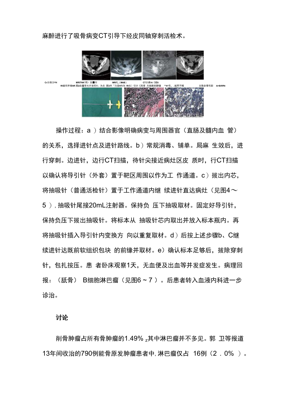 CT引导下同轴穿刺活检确诊骶骨淋巴瘤病例报告.docx_第2页