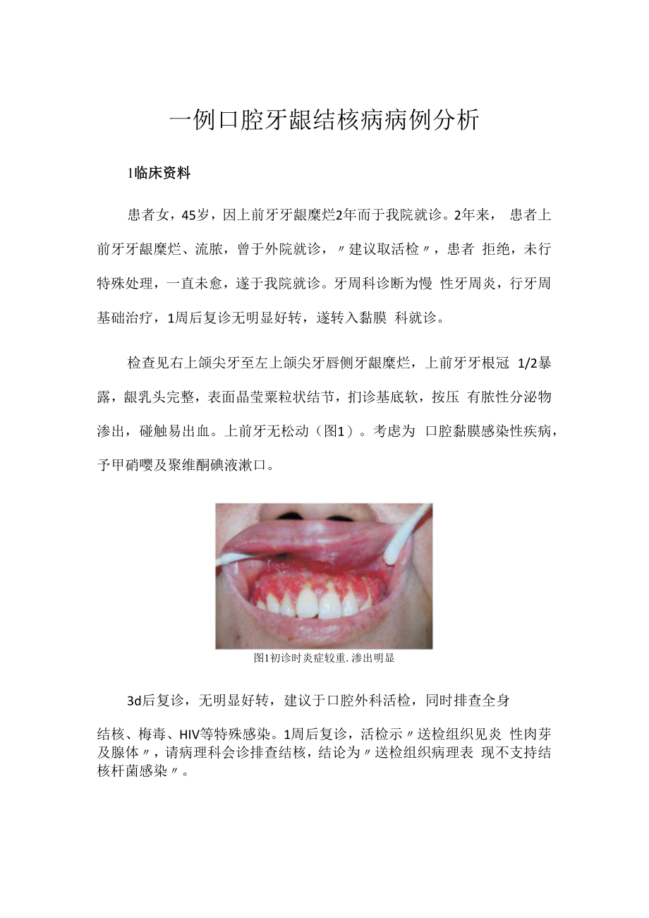 一例口腔牙龈结核病病例分析.docx_第1页