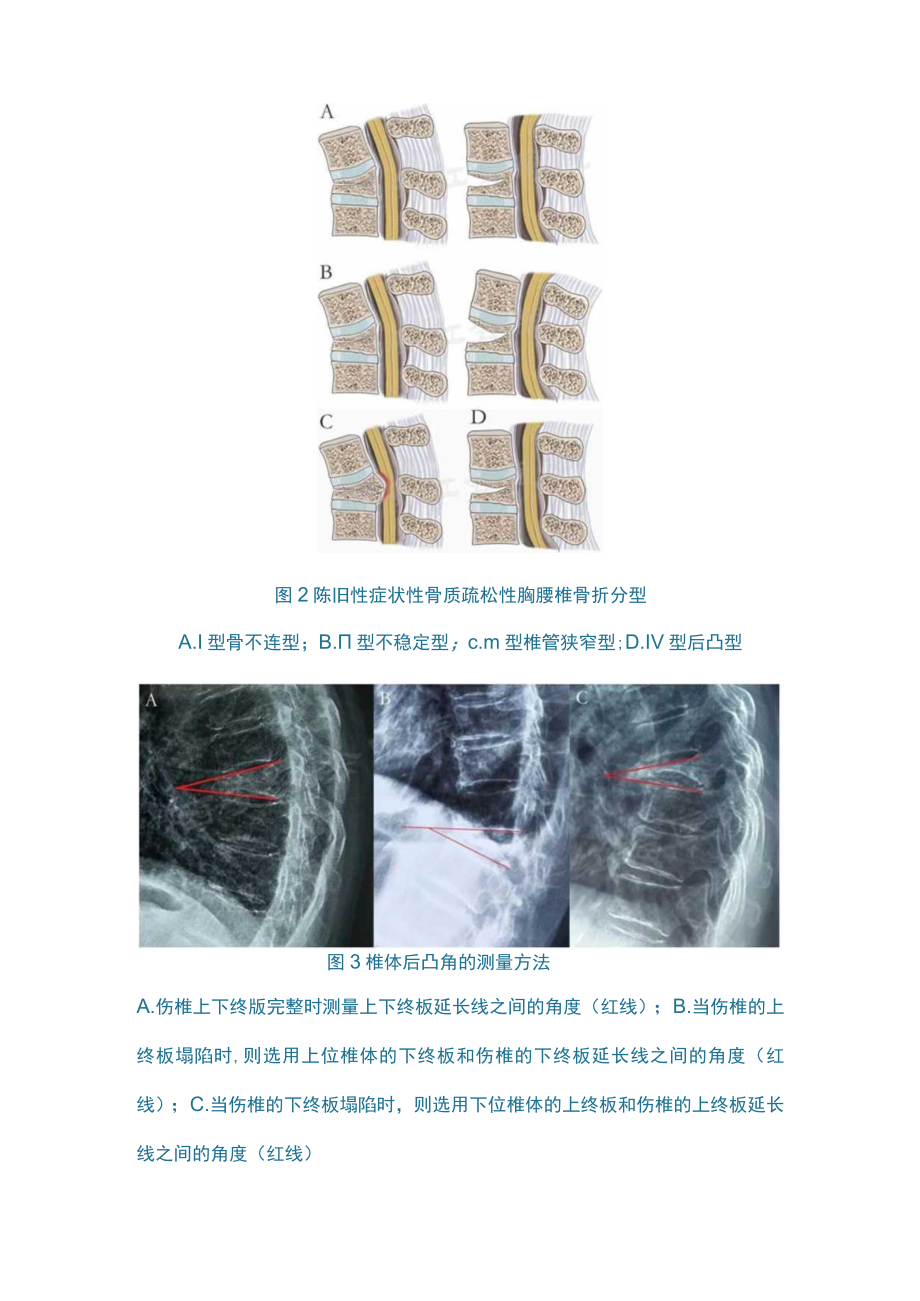 骨质疏松性胸腰椎骨折（全文）.docx_第3页