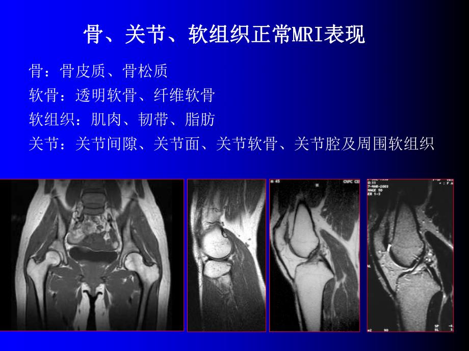 磁共振成像诊断骨关节及软组织疾病.ppt_第3页