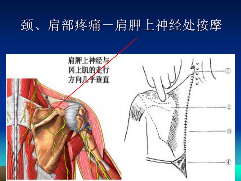 疼痛的自我按摩治疗.ppt_第3页