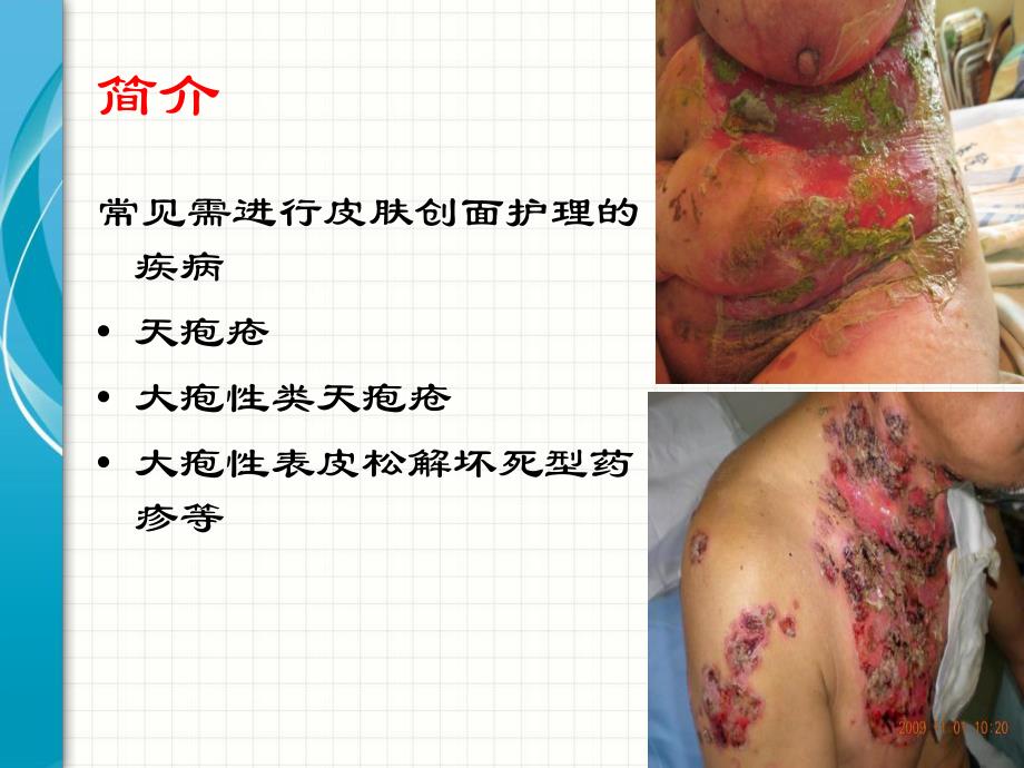 疱病护理.ppt_第3页