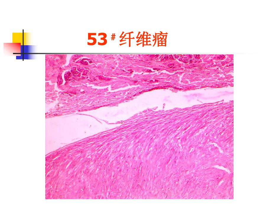 病理学1肿瘤.ppt_第3页