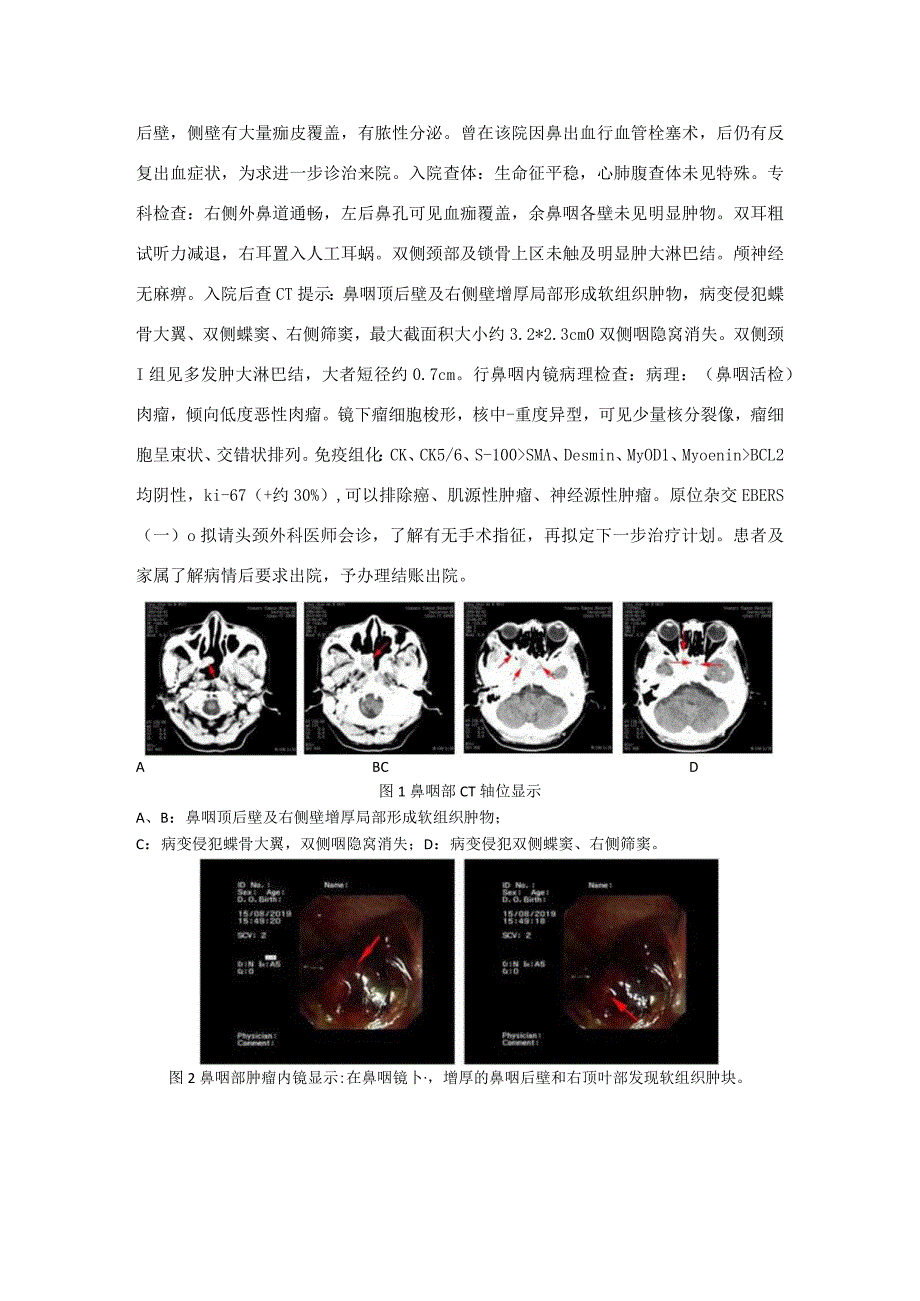 鼻咽癌放疗后诱发肉瘤1例并文献复习.docx_第2页