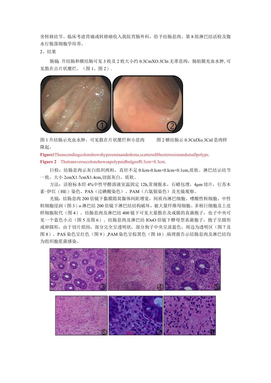 结肠及淋巴结组织胞浆菌病1例并文献复习.docx_第2页