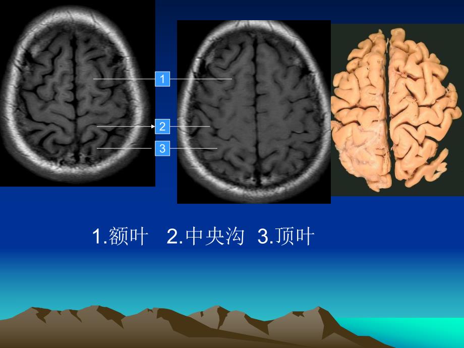 头颅MRI断层解剖名师编辑PPT课件.ppt_第3页