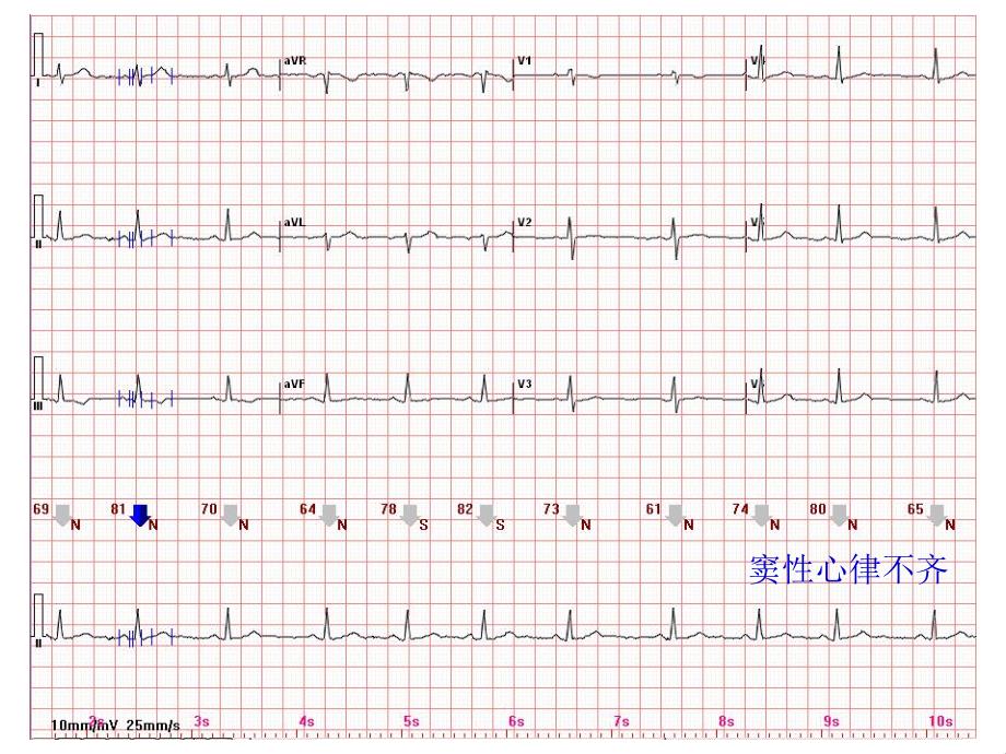 心电图常见正常和异常心电图图谱.ppt_第3页