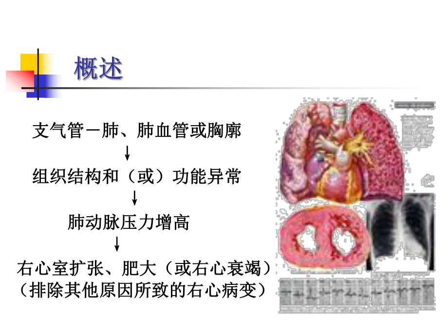 慢性肺源性心脏病ppt课件.ppt_第3页