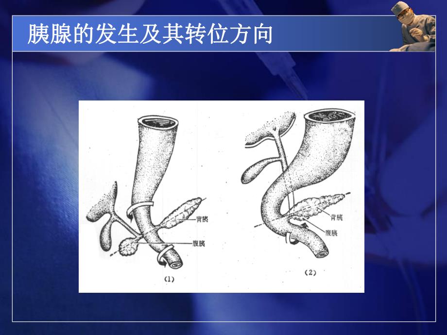 急性胰腺炎.ppt_第3页