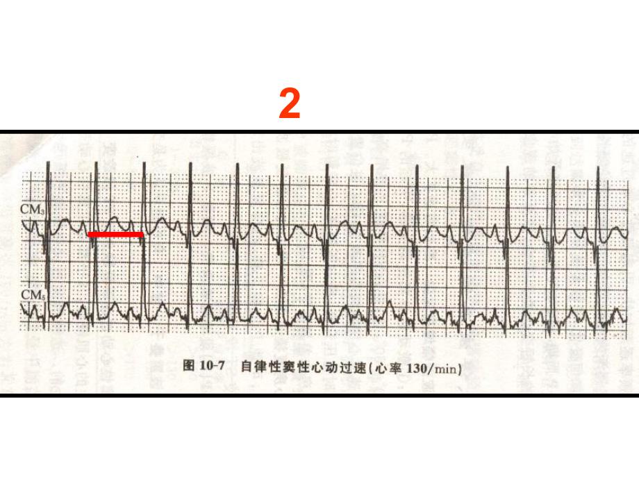 心电图考核图谱.ppt_第3页