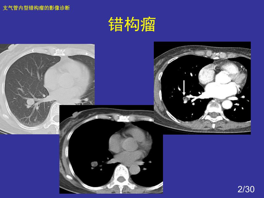 支气管内错构瘤的影像诊断.ppt_第2页