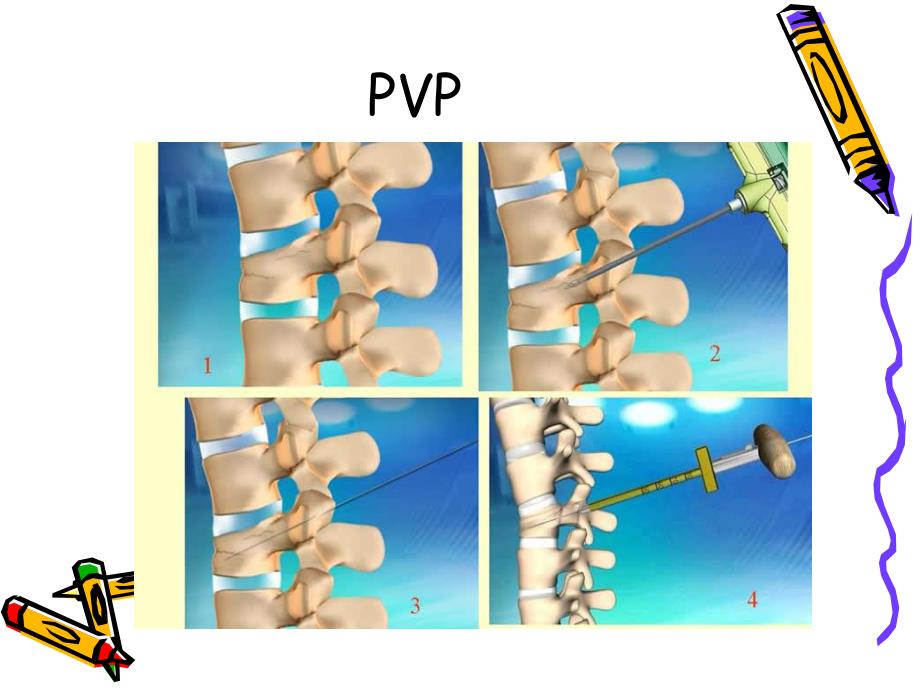 椎体成形术手术步骤.ppt_第3页