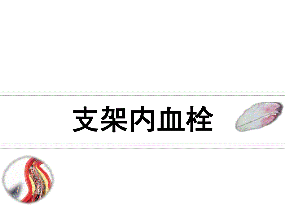 支架内血栓.ppt_第1页