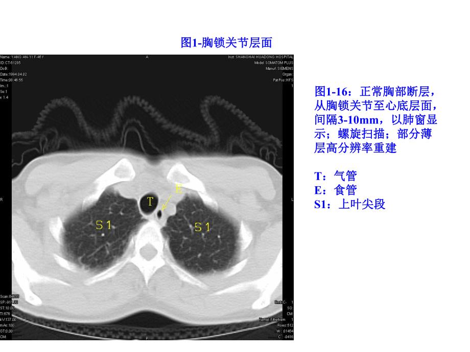 正常胸部CTWXM .ppt_第2页