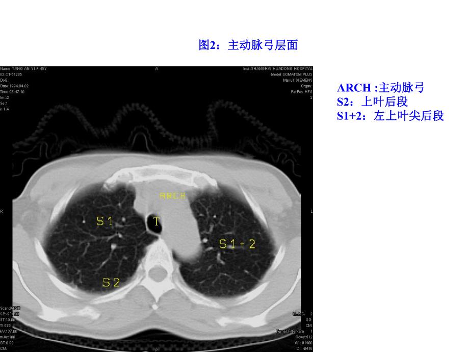 正常胸部CTWXM .ppt_第3页