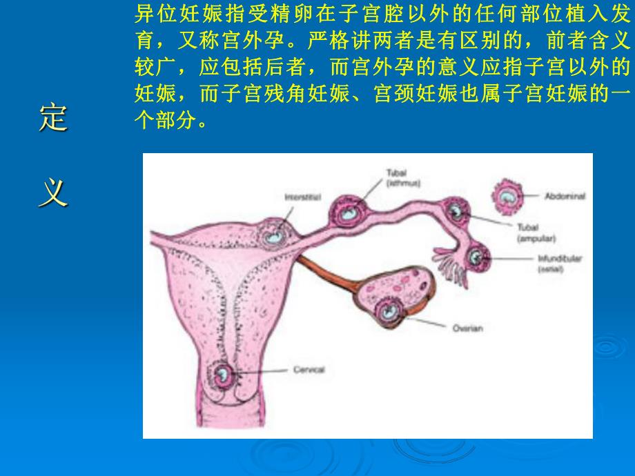 妊娠黄体与宫外孕的鉴别诊断名师编辑PPT课件.ppt_第3页