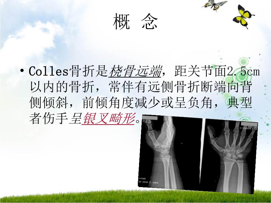 COLLES骨折可用.ppt_第3页