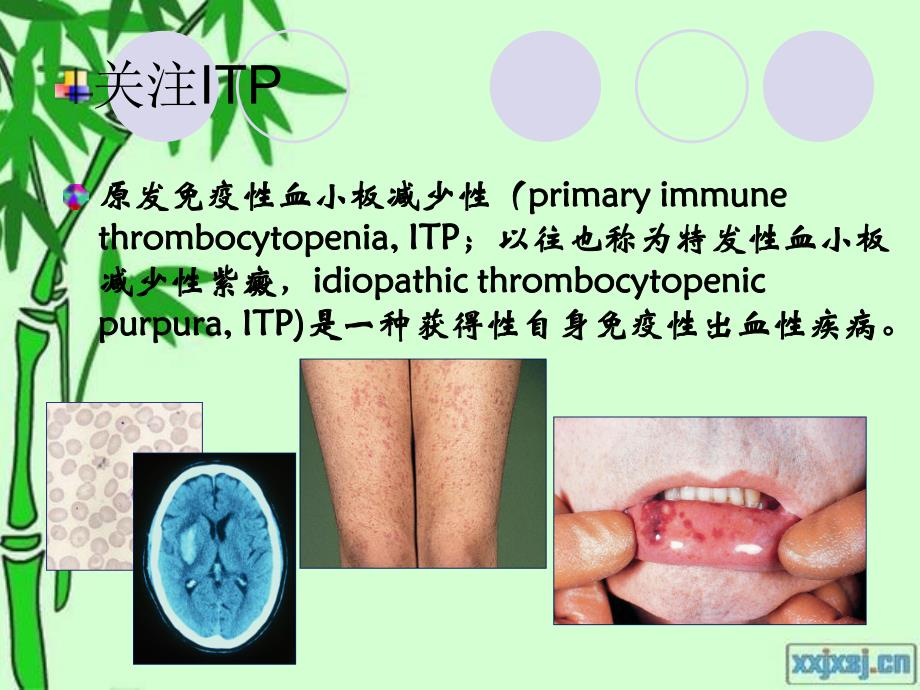 ITP的中西医诊断与治疗.ppt_第2页