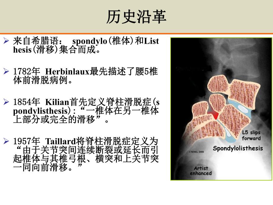 微创与开放手术治疗III度腰椎滑脱症.ppt_第2页