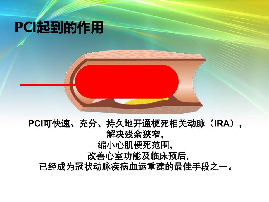 PCI围手术期他汀类药物的应用研究.ppt_第3页