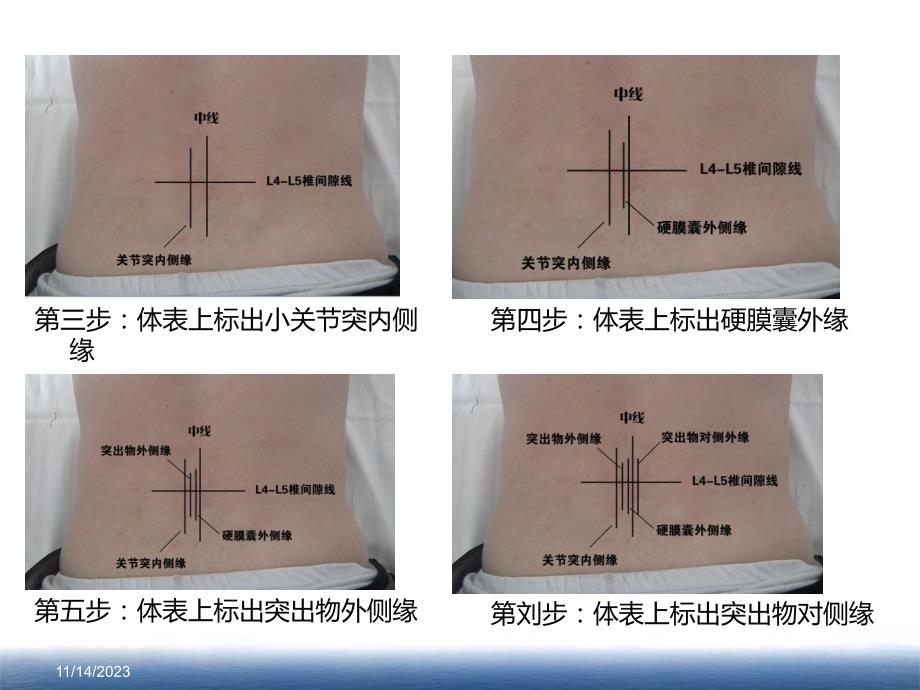 椎间孔镜后路操作步骤【ppt】 .ppt_第2页