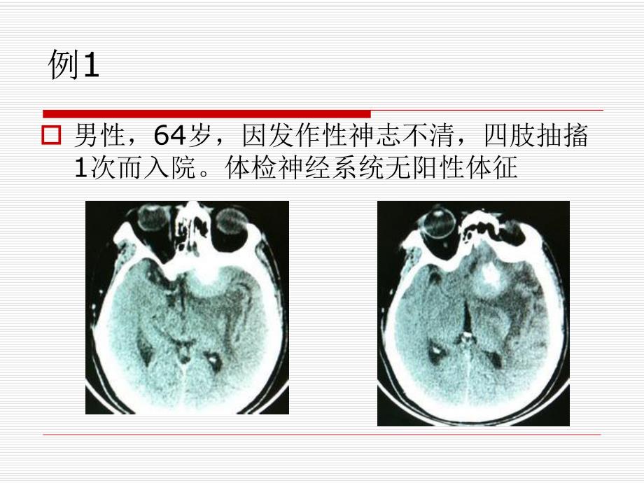 开颅手术中血管损伤的经验教训.ppt_第2页