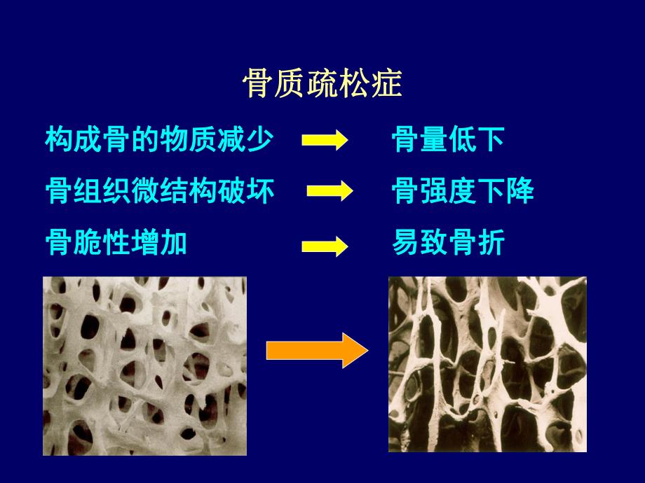 精品原发性骨质疏松症.ppt_第3页