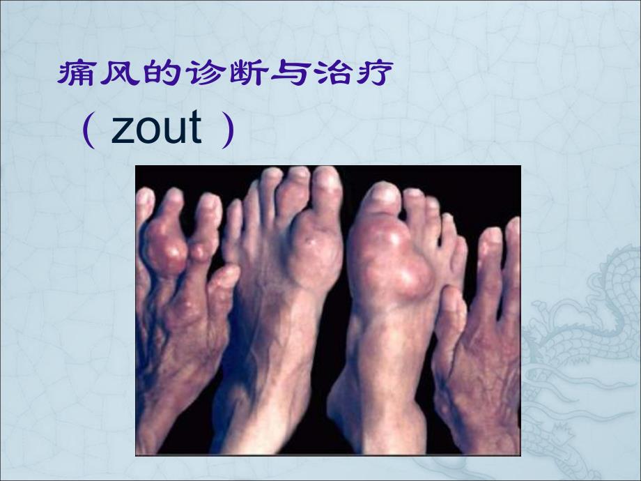 痛风的诊断与治疗讲课.ppt_第1页